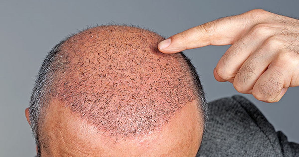 FREQUENTLY ASKED QUESTIONS - Asuman Hair Transplant
